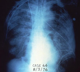 Xray-chest